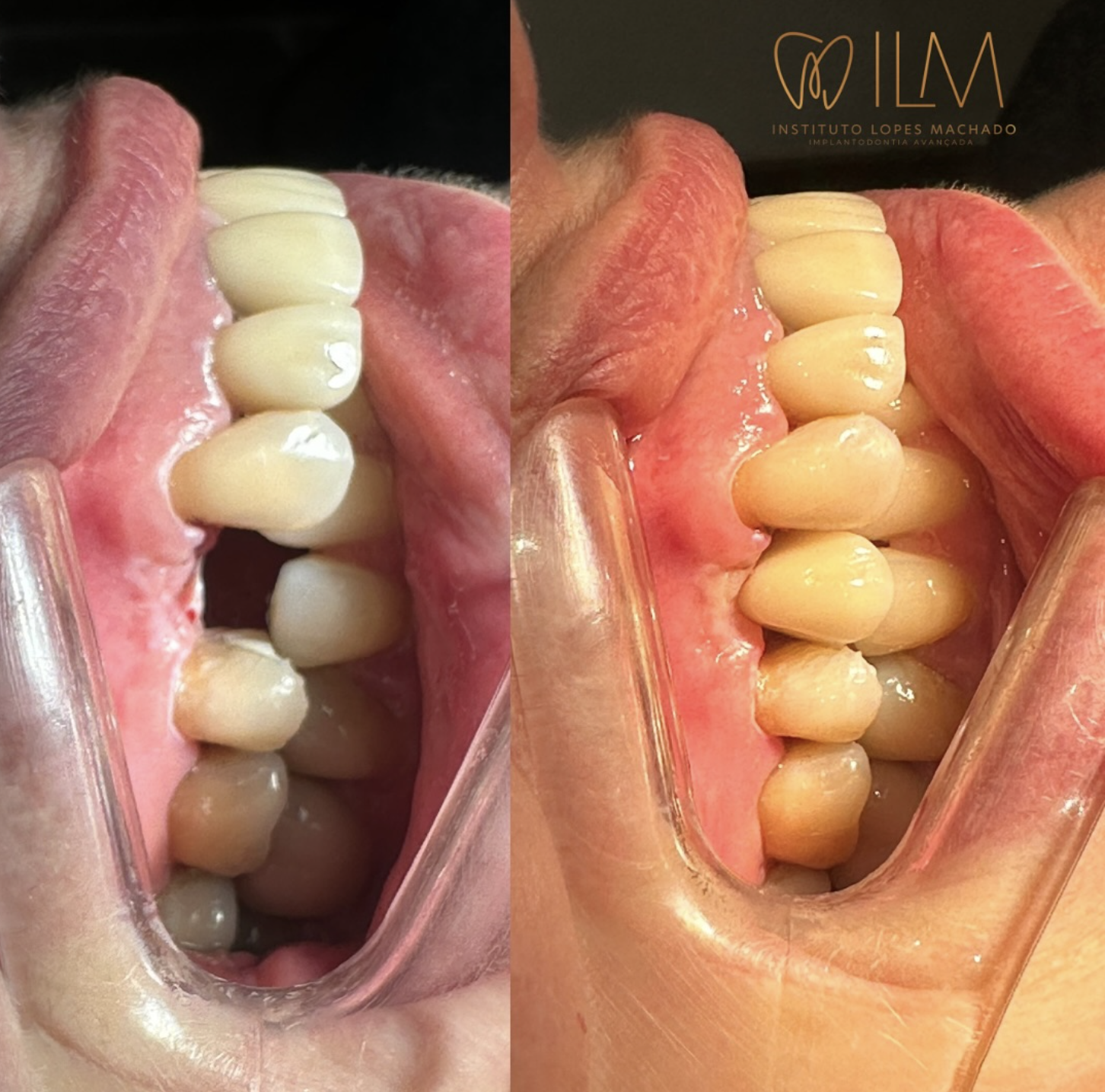 Procedimento ILM